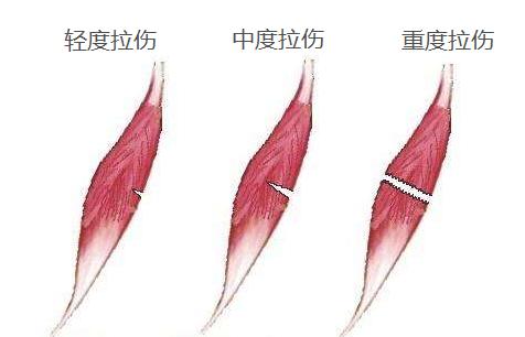 Jennie跑个步把自己整瘸了,还浑身淤青 过度健身不可取,太心疼了