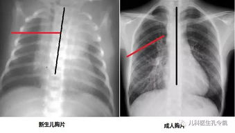 肋骨外翻是什么 与缺钙有关吗