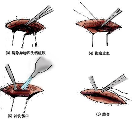 清创术(清创术简介)