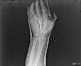 开放性左第三掌骨头粉碎性骨折治疗探讨