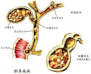 胆结石致命么 有没有必要动手术