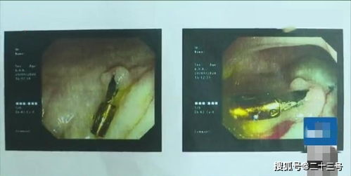 男子做肠道手术后,肚子疼了两年,一检查怒了 肠子里有个钳子