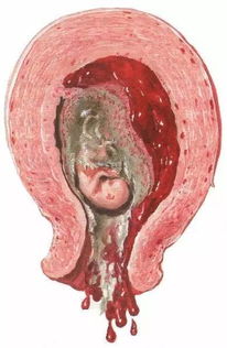 自然流产后内膜是4,自然流产后一周子宫内膜厚度为多少是正常的