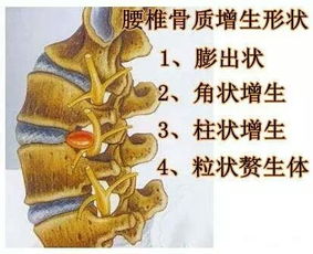 古冰逍告诉你骨质增生是怎么引起的