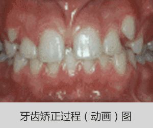 大连齿医生口腔科普 牙齿矫正要几年才算是正常的