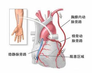 人们对冠心病的认知缺乏,令人堪忧 是时候学习了 