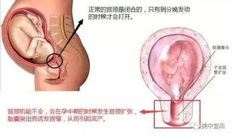 怀孕21周子宫大门险打开,开腹环扎锁住宝宝生命线 