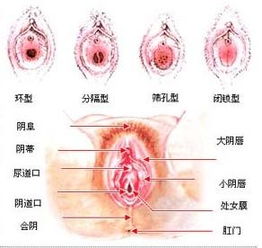 处女膜闭锁怎么办？