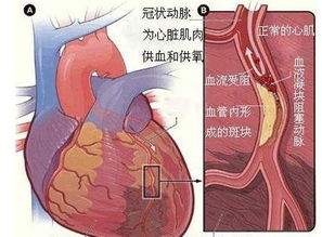 心肌梗塞会不会遗传