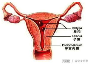 子宫内膜息肉是什么?能直接做试管婴儿吗?