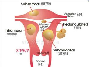 子宫肌瘤是什么病 子宫肌瘤是什么疾病