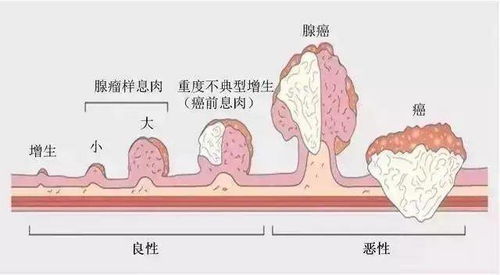 健康提醒 别再忽视这种病,它对任何人都一视同仁