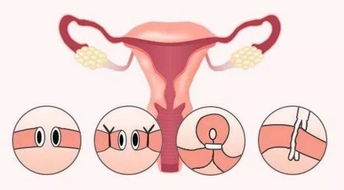 聊城女性输卵管结扎能复通吗