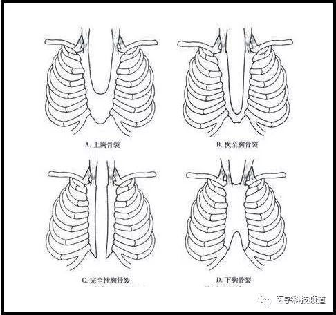 出生30天宝宝的超级手术 重度胸骨裂 先心病手术 