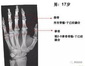 收藏丨骨龄图谱 方便随时对照