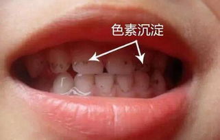 3岁孩子，牙齿烂了4颗，为啥医生选择先补烂得较轻的牙齿，最后补烂得厉害的