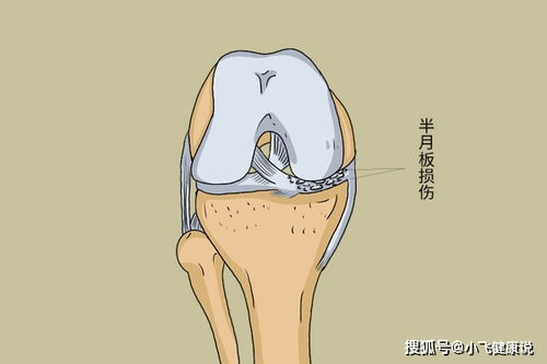 拉伤和劳损治疗方法有哪些区别？