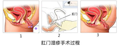 长沙东大肛门潮湿是怎么引起的 