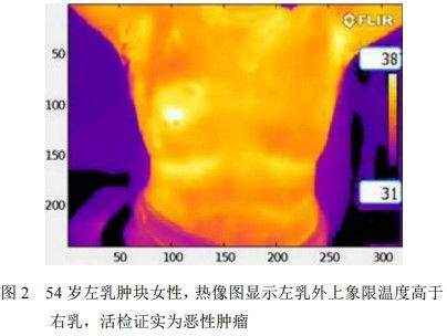 红外热成像检查髂腰肌