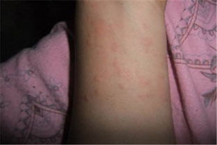 导致慢性的荨麻疹的主要原因有哪些
