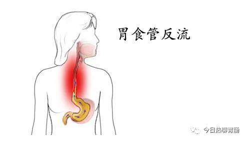 胃食管反流病患者要分清抗酸药和抑酸药,吃对了才有效