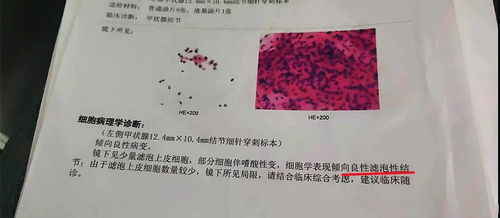 4次B超确诊4a类甲状腺结节,患者不接受手术,最终选择保守治疗