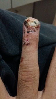 手指2个月前末端粉碎性骨折过,指甲没了,3天前不小心把又砸了出来两个血泡会影响指甲生长吗还有血泡会 