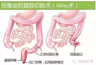 想要菊花好,肛毛不能倒