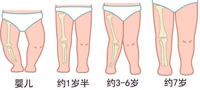 16岁女孩因O型腿不愿上学,专家 想孩子腿型好看,这4件事要重视