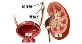 李俪医生 肾结石如何护理比较好