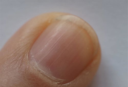 指甲上的月牙消失是怎么回事