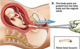 女孩子流产是怎么 打掉 的 72.6 的人看完后,不敢流产了