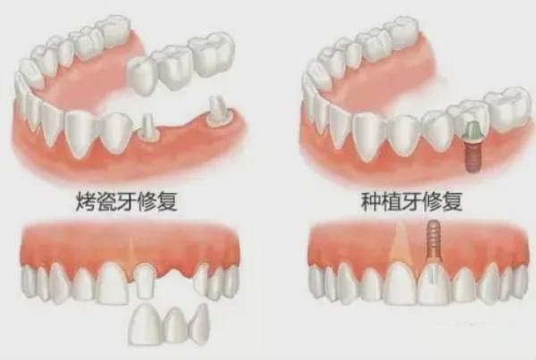 种植牙 你想知道的问题都在这里......