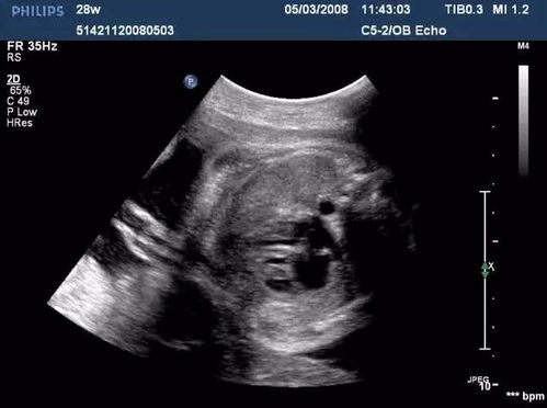 什么是胎儿心超检查，产前四维超声能代替胎儿心超检查吗