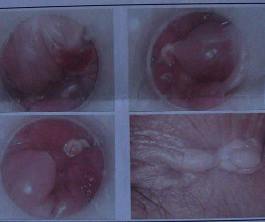 肛门处长了一个肉疙瘩是怎么回事 