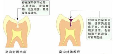 窝沟封闭 并非人人都需要