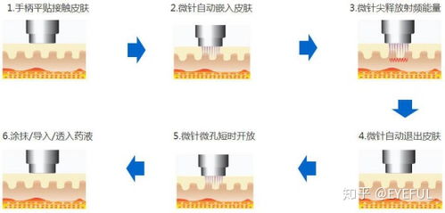 抽脂溶脂哪个更好 