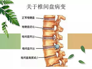 腰间盘突出的症状自测 外伤性腰椎间盘突出是原有疾病，法医是怎么做伤情鉴定的？ 