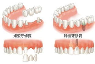 老人镶牙哪种性价比高