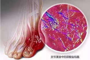 高尿酸 ,伤肾大家知道吗 