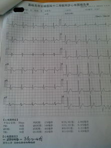体检结果请医生帮忙看一下 以前做心电图是预激 没有发病症状 这次为啥做心电图就正常了 