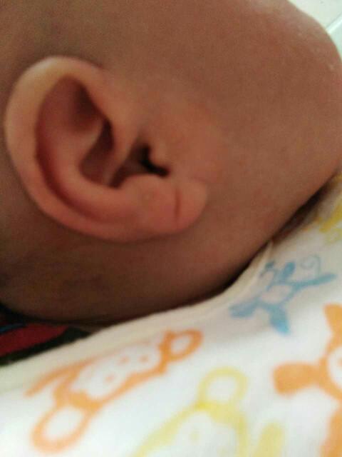 宝宝43天,两边耳垂上有折痕,最近才发现,出生时没注意 