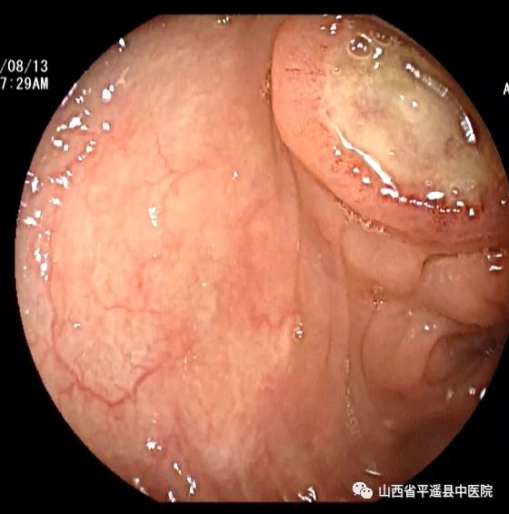 中医院成功开展首例无痛肠镜检查