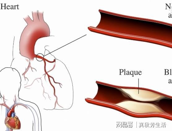 人到多大年龄血管容易堵 又有什么样的食物可以帮助清血管