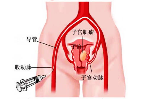 宫腔镜切除息肉子宫肌瘤手术后10天出血适中伴有腹痛正常吗?该如何?