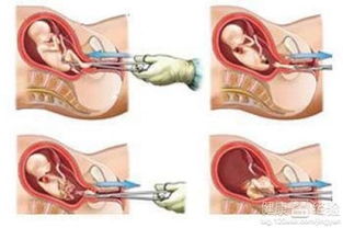 无痛人工流产手术？无痛人工流产手术步骤