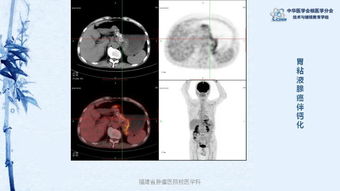 28期 林端瑜 PET CT显像在胃肠道肿瘤中的应用