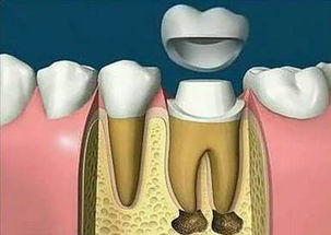 牙齿为什么要抽牙神经