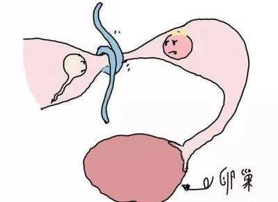 输卵管结扎了能怀二胎吗？输卵管复通术后有哪些注意的吗？
