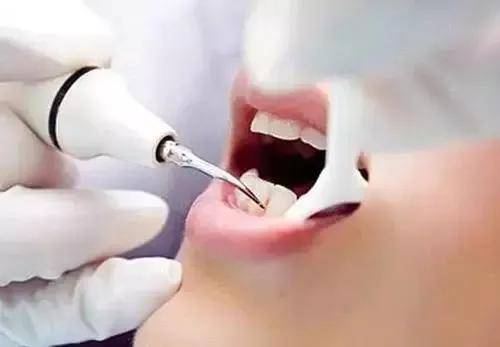 福清口腔医院 洗牙是什么 作用有哪些 危害有吗